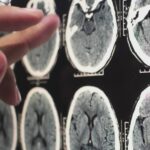 Allarme glioblastoma nei giovani: +230% in 20 anni